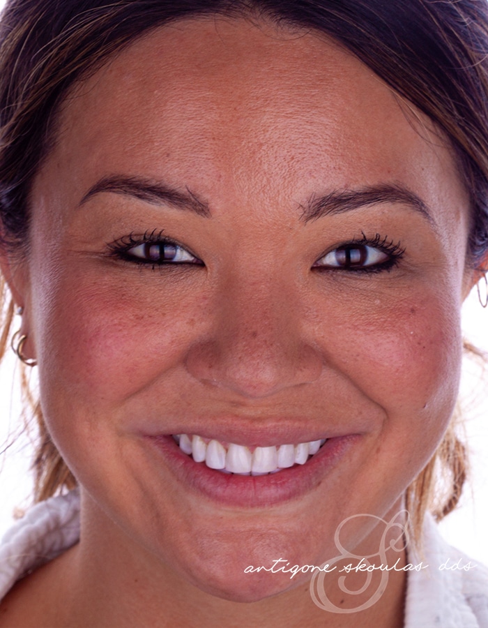 Patient - Composite Veneers