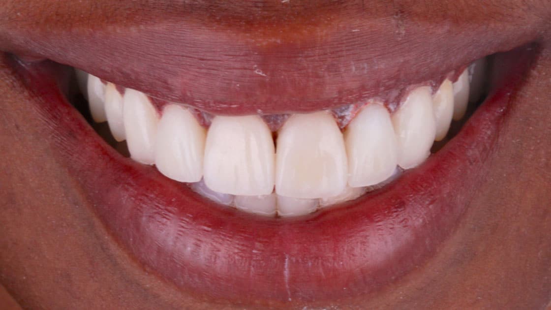 TANYA Porcelain Veneers AFTER SMILE