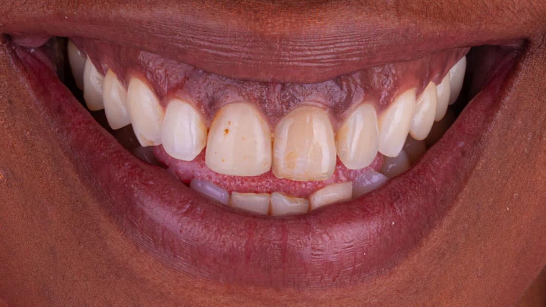 TANYA Porcelain Veneers BEFORE SMILE