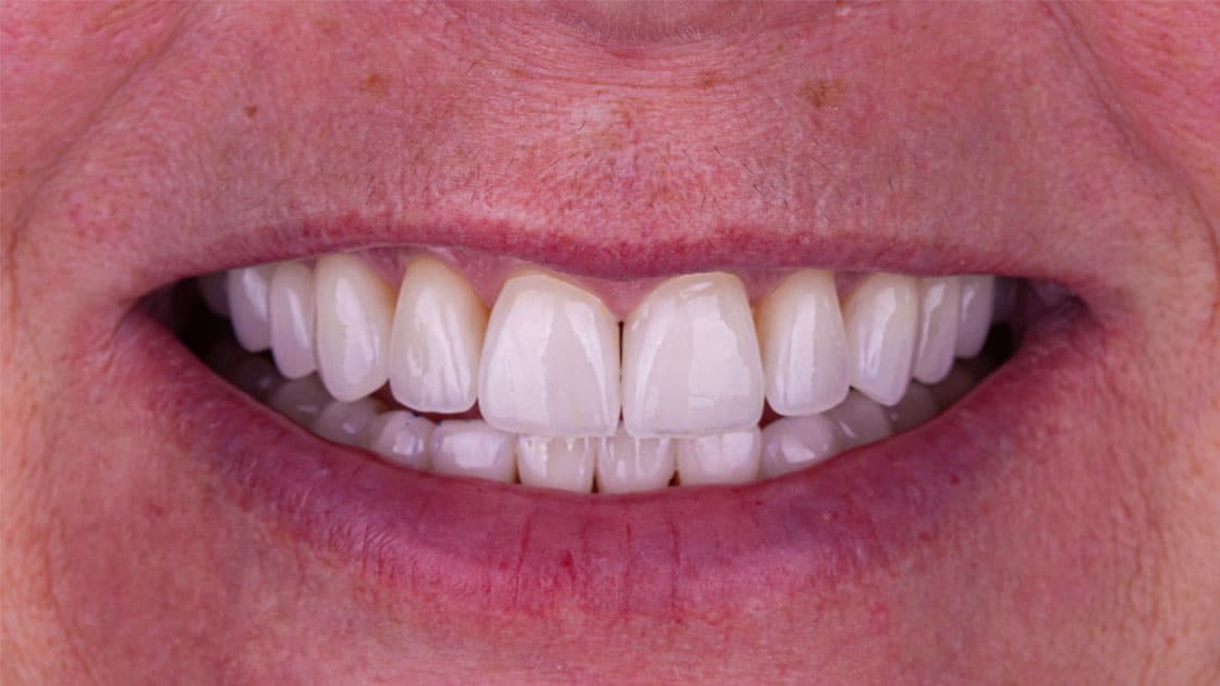 THERESA Porcelain Veneers AFTER SMILE