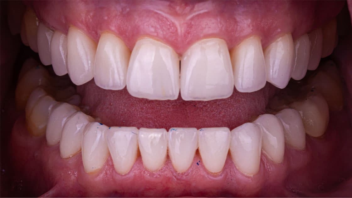 THERESA Porcelain Veneers AFTER TEETH