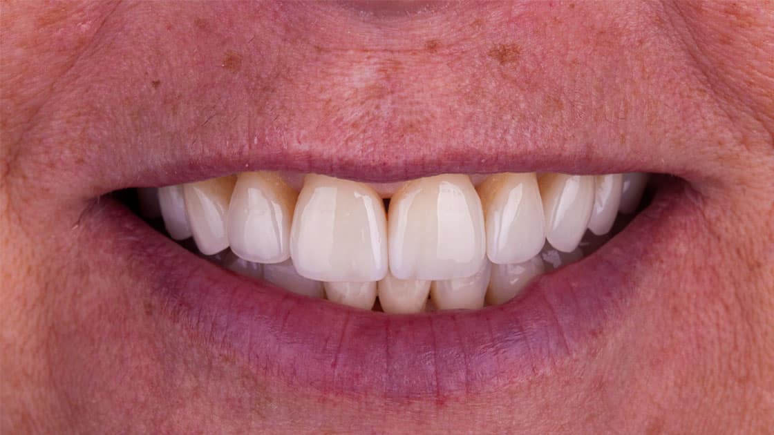 THERESA Porcelain Veneers BEFORE SMILE