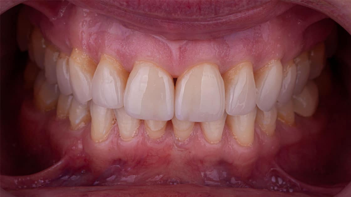 THERESA Porcelain Veneers BEFORE TEETH