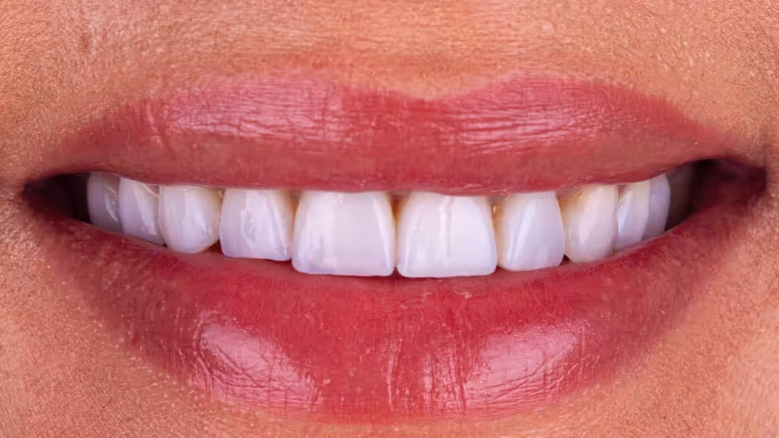Valery VENEERS AFTER SMILE