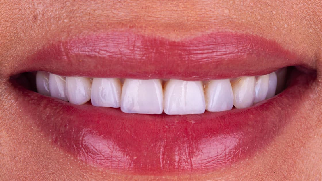 Valery VENEERS AFTER SMILE