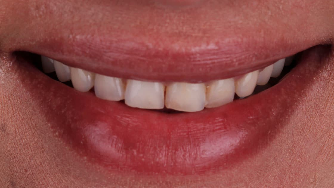 Valery VENEERS BEFORE SMILE