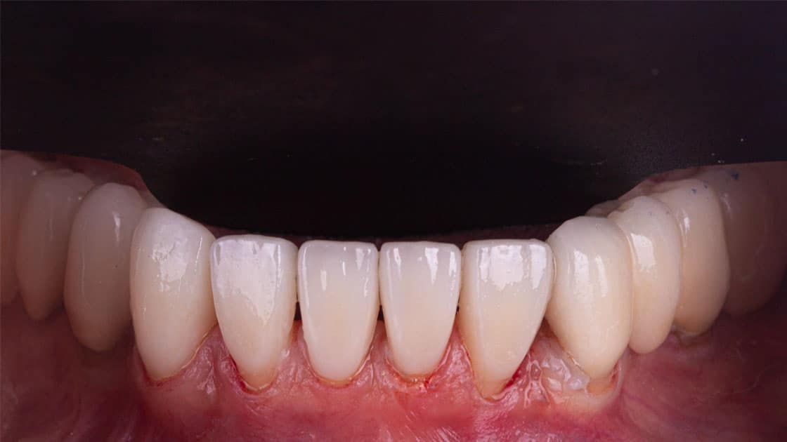 Vanessa AFTER veneers teeth