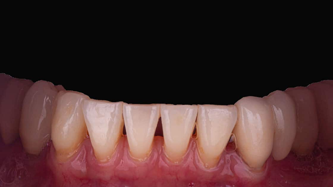 Vanessa BEFORE veneers teeth