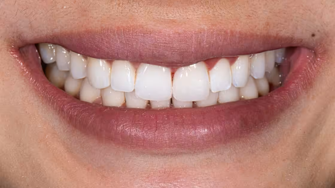 Case 2 smile-after