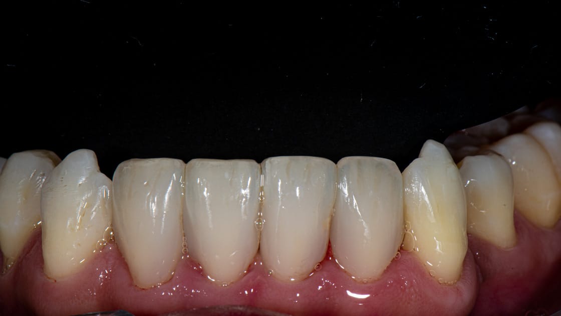 Case 4-teeth-after