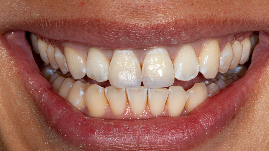 WENZ-Composite Veneers-AFTER-SMILE