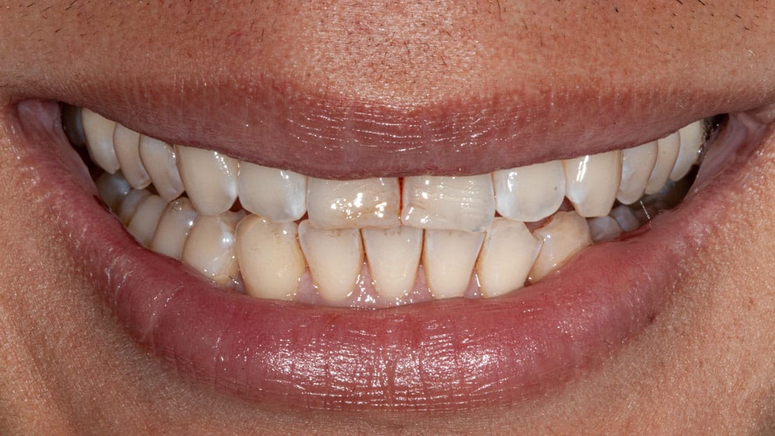 WENZ-Composite Veneers-BEFORE-SMILE