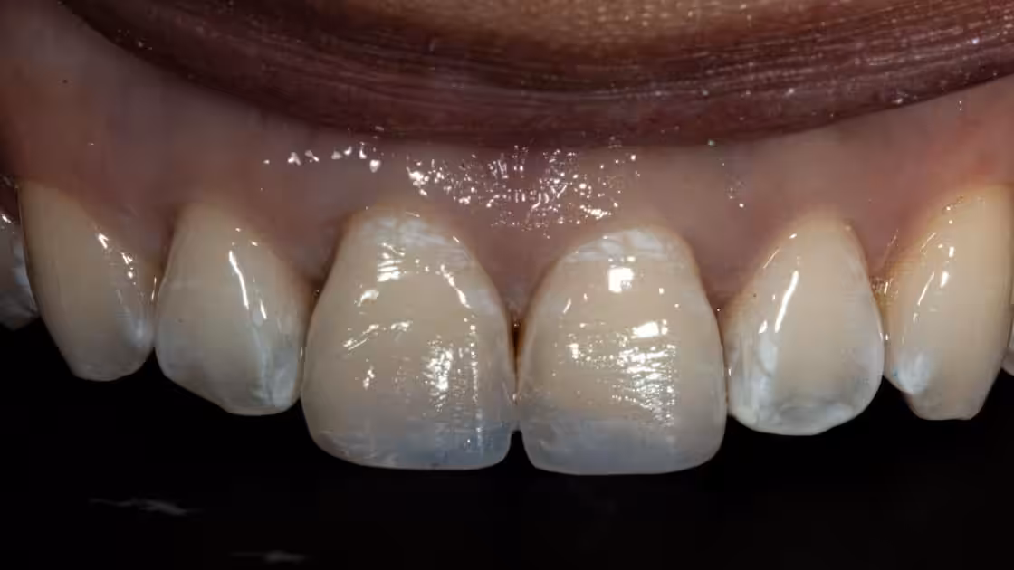 Veneers AFTER teeth