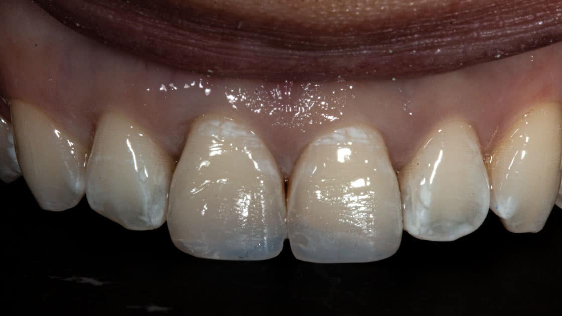 Veneers AFTER teeth