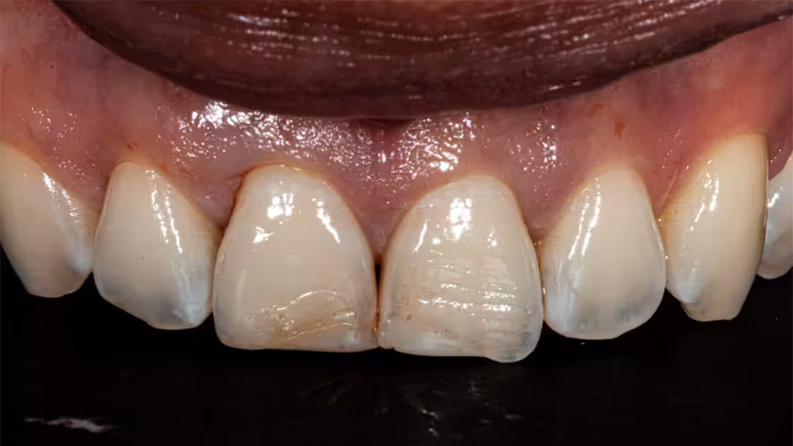 Veneers BEFORE teeth