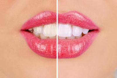 White Teeth Comparison