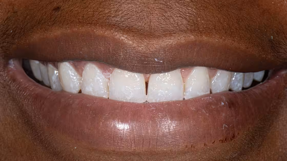 Gummy smile after