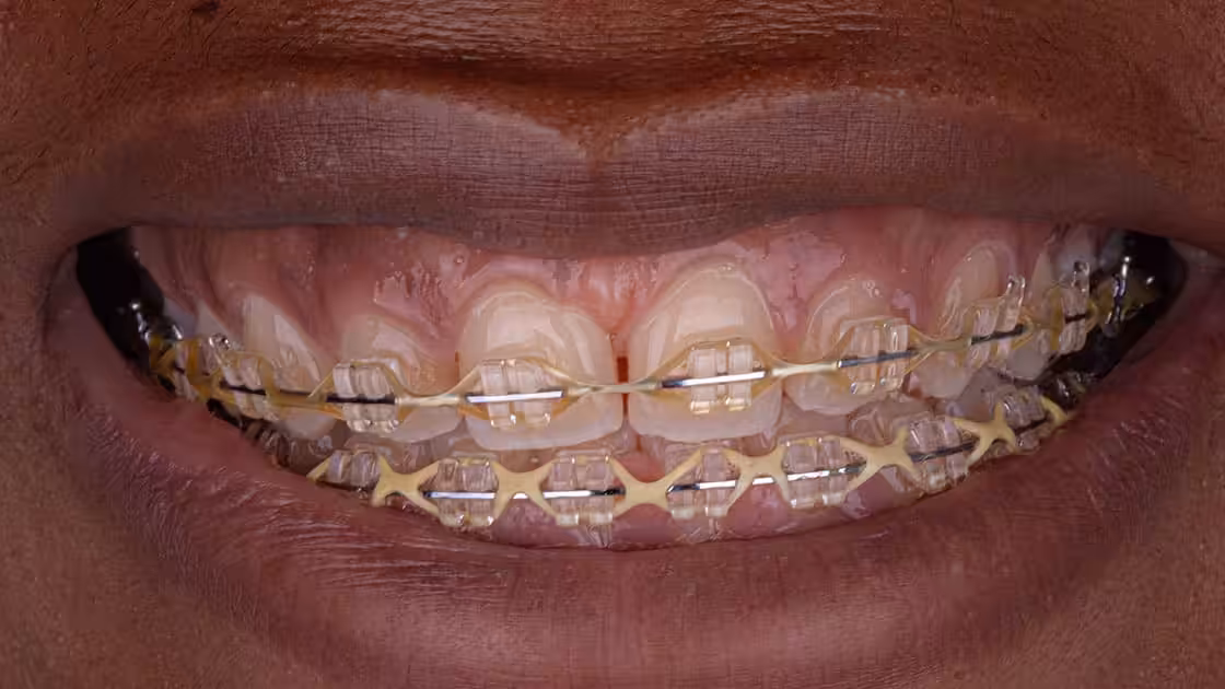 Gummy smile before