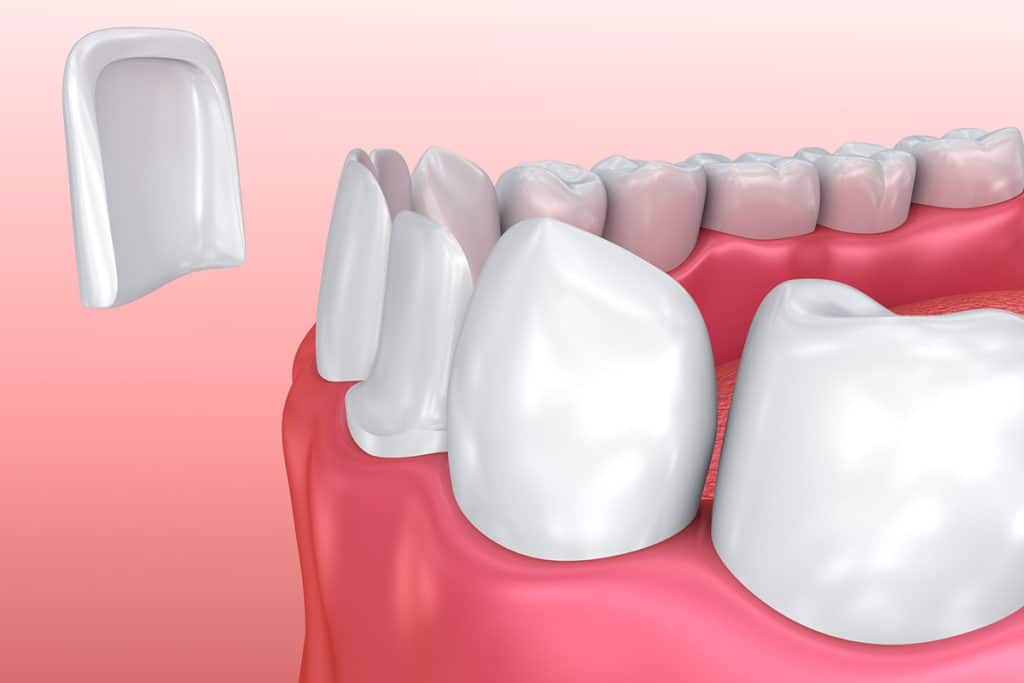 Are dental veneers healthy and minimally invasive?