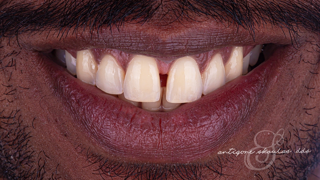 Invisalign Before Photo 1