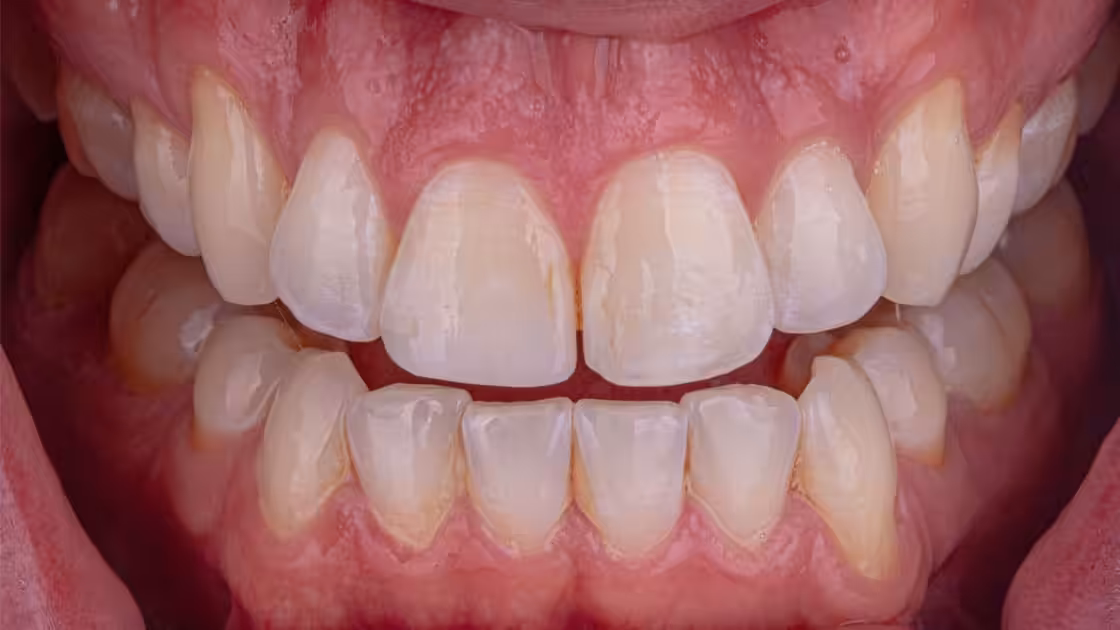 Case 1-teeth-before