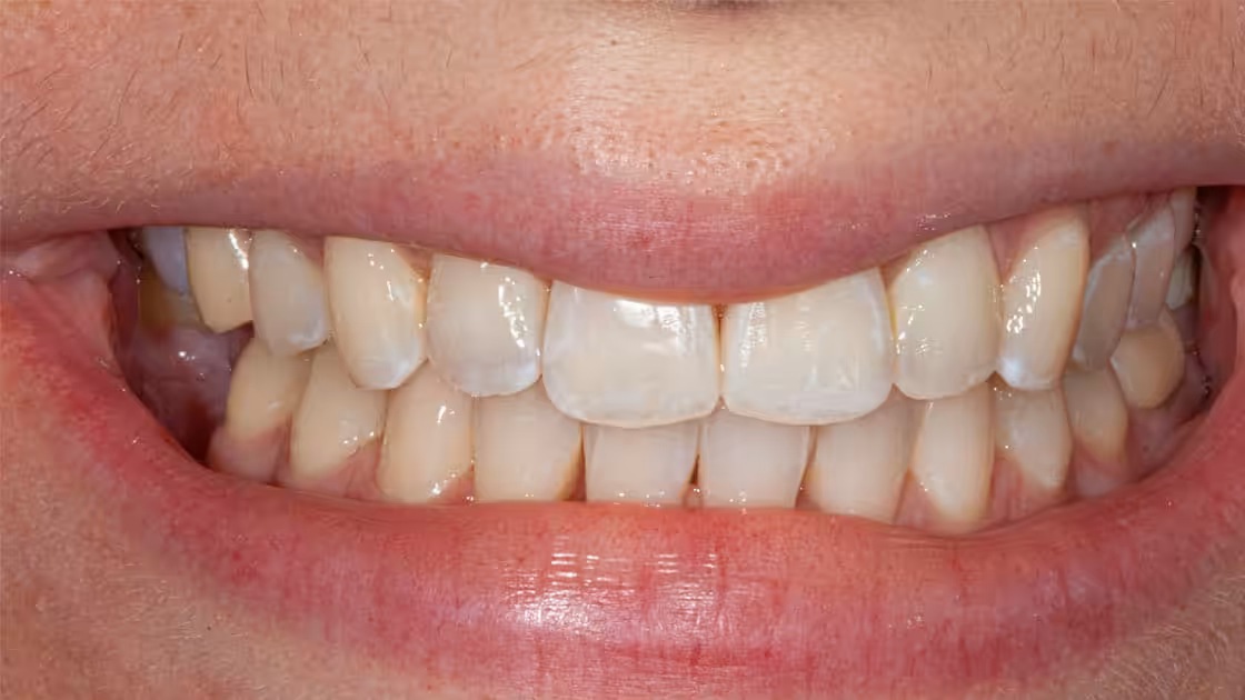 Case 2 after smile