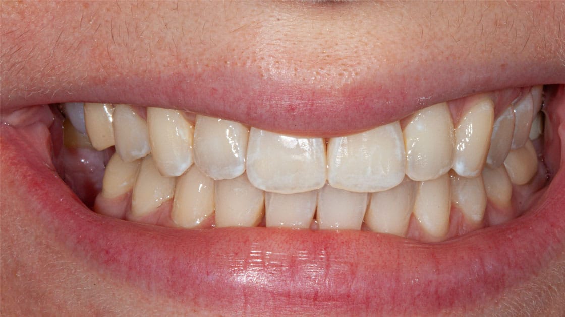 Case 2  after smile