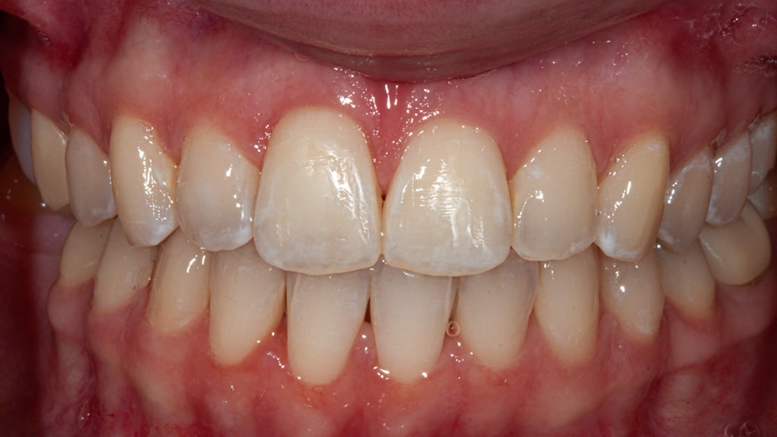 clarissa teeth after