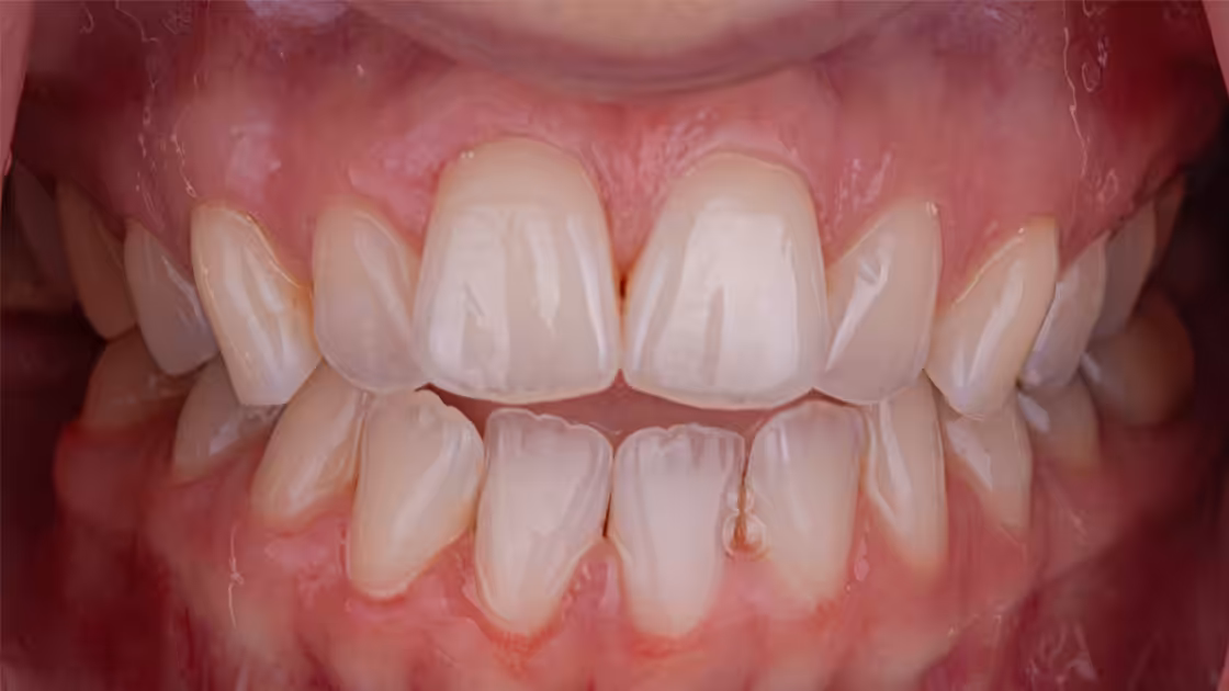 Case 2 teeth before