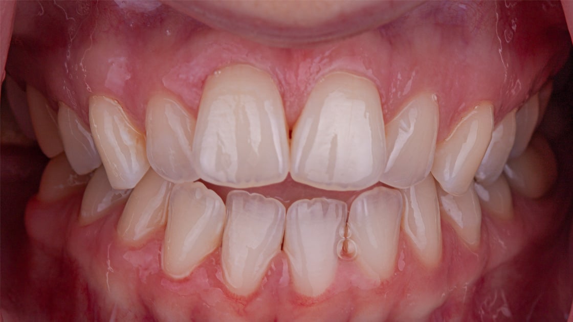 clarissa teeth before