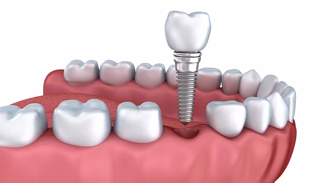 Single Dental Implant Photo