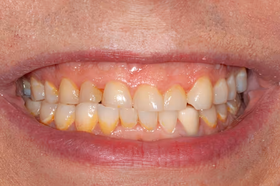 Gum Contouring Photo