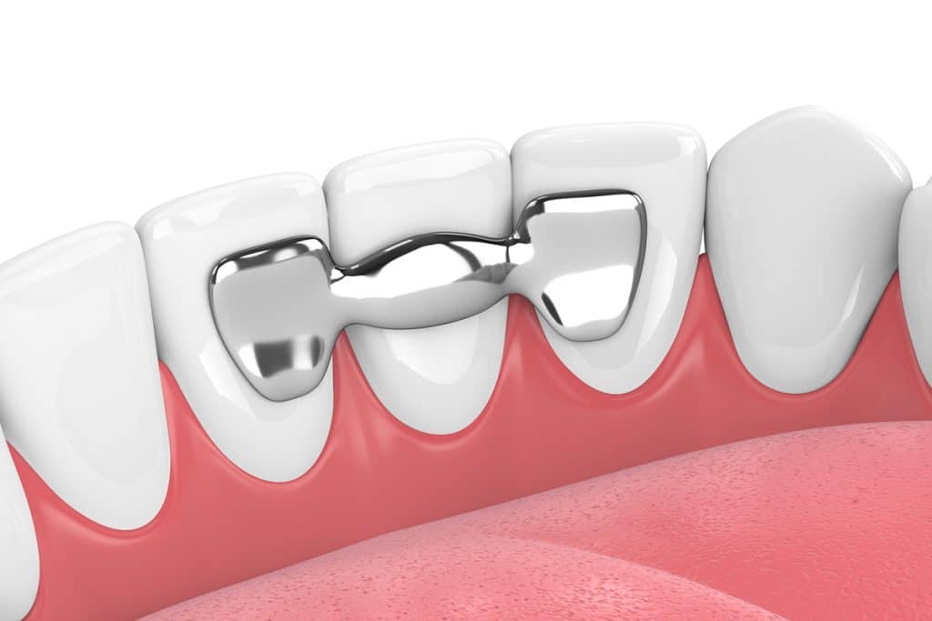 How Long Do Dental Bridges Last?