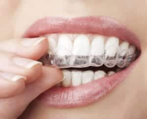 invisalign-orthodontics-for-working-professionals