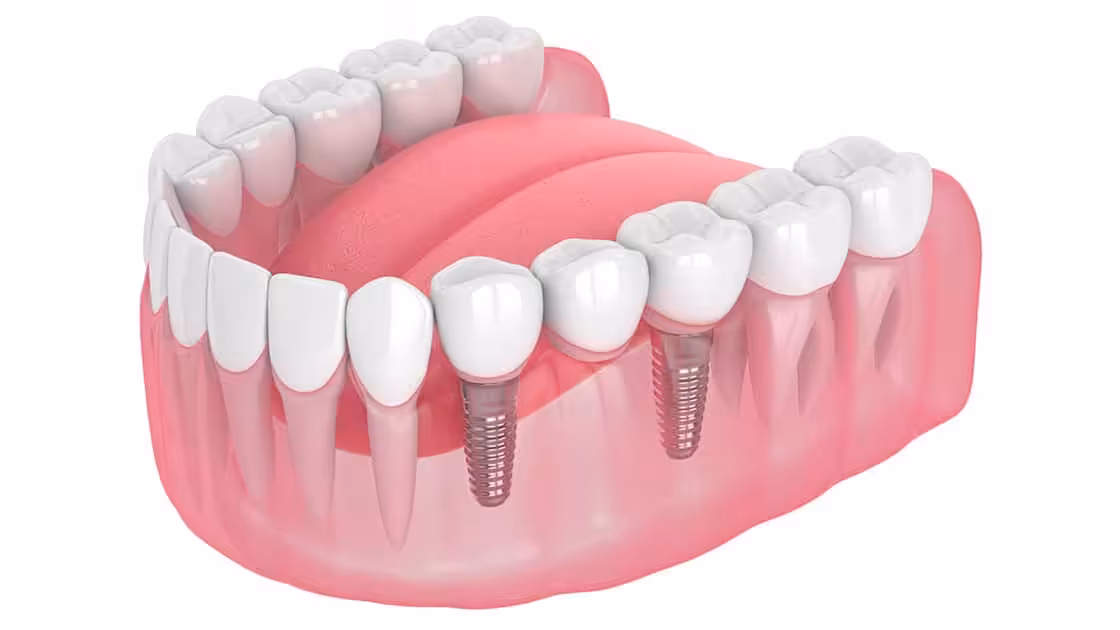 Implant Supported Bridge Graphic