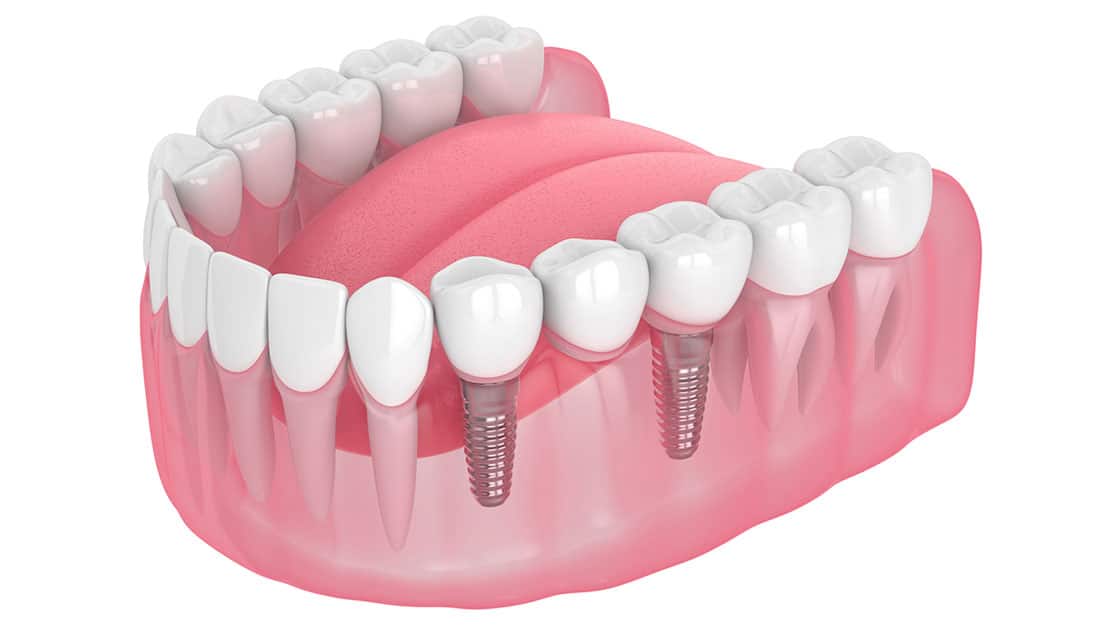 Implant Supported Bridge Graphic