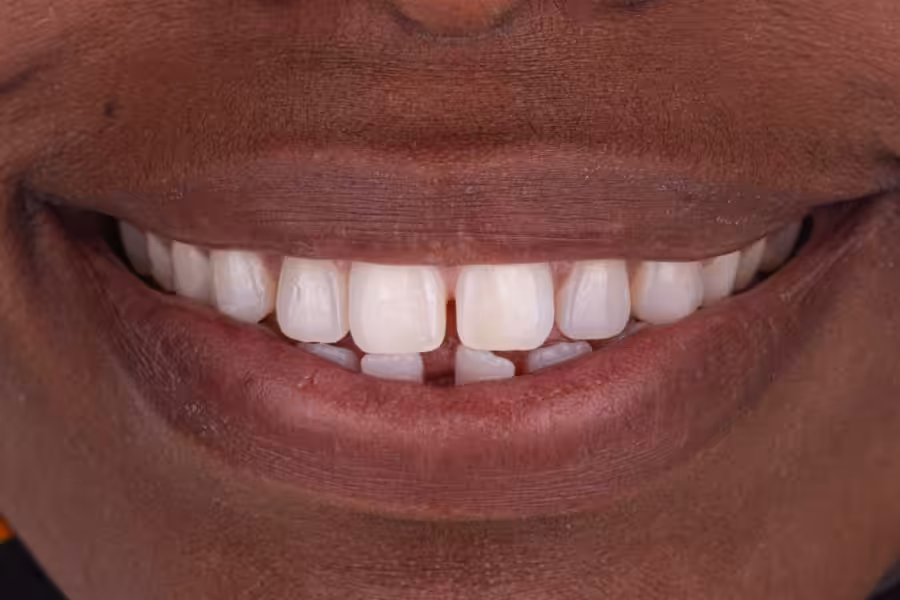Invisalign Photo