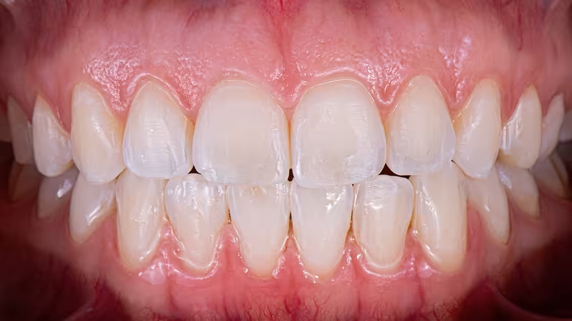 Case 4 Smile afer