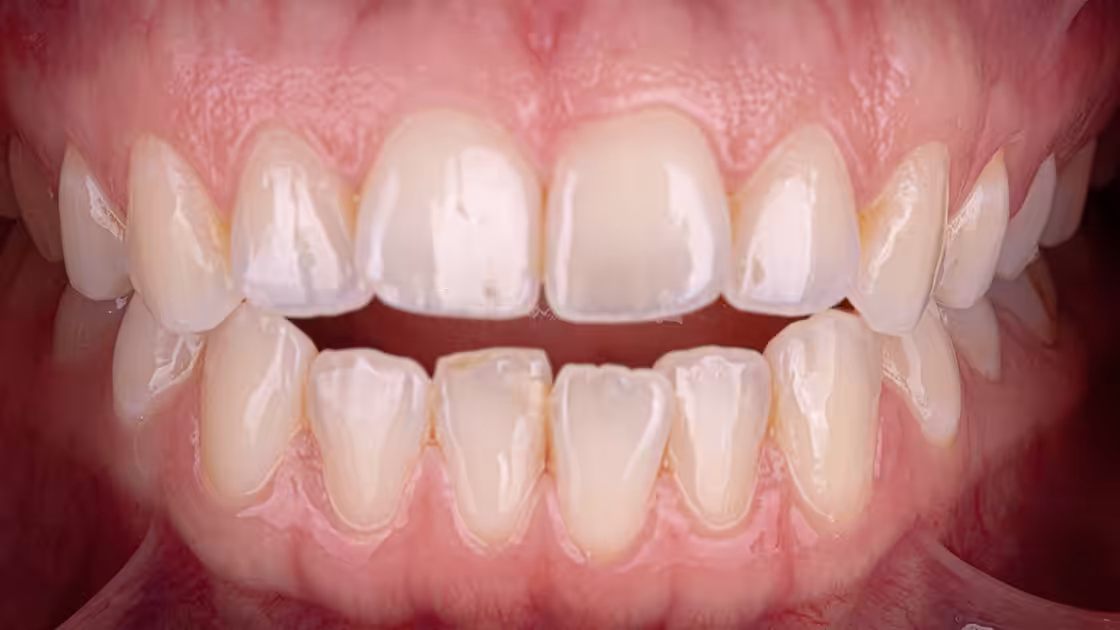 Case 4 Smile before