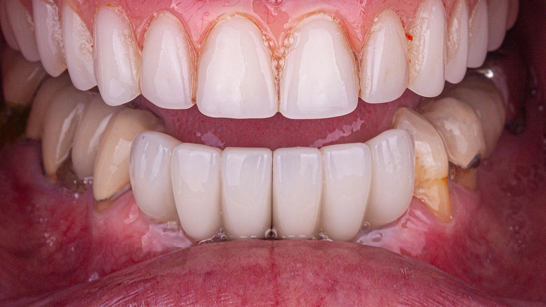 Dentures Photo