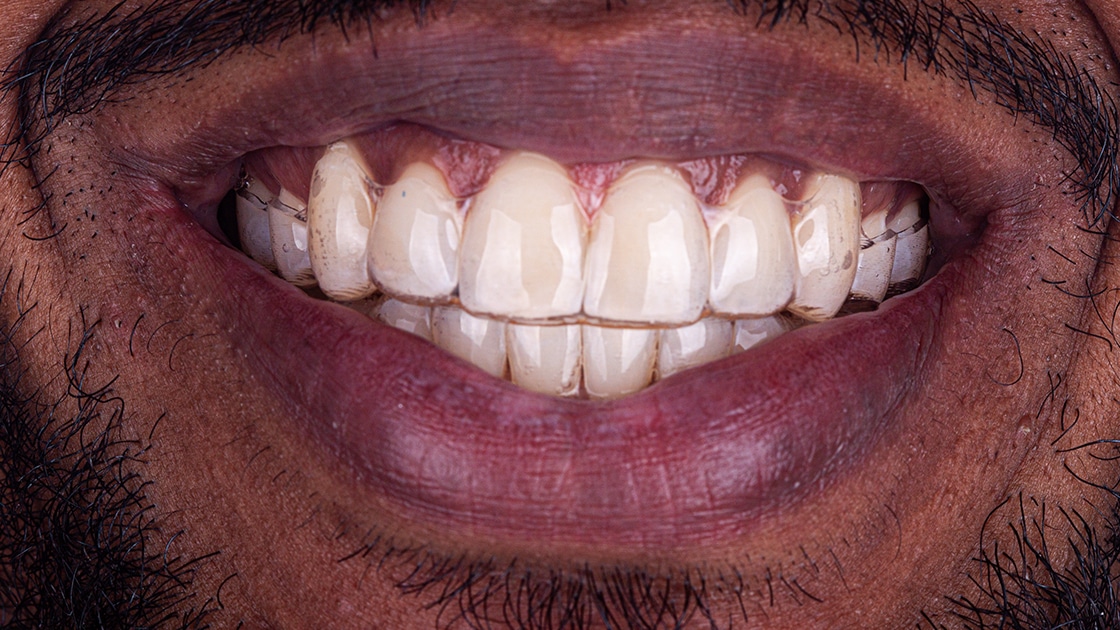 Invisalign patient photo