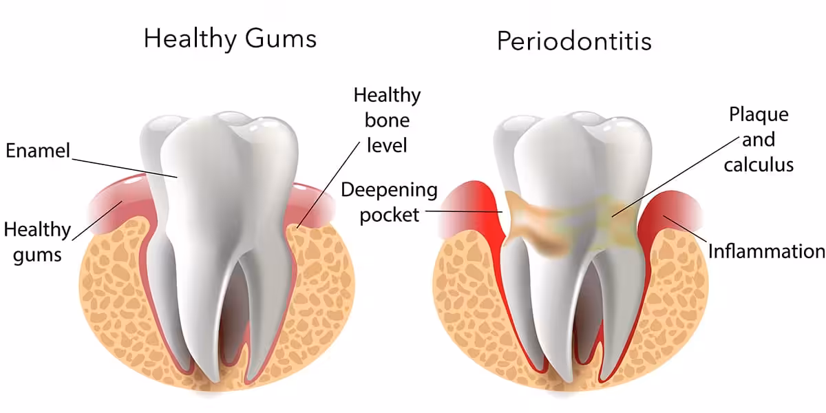 Healthy gums vs periodontitis graphic