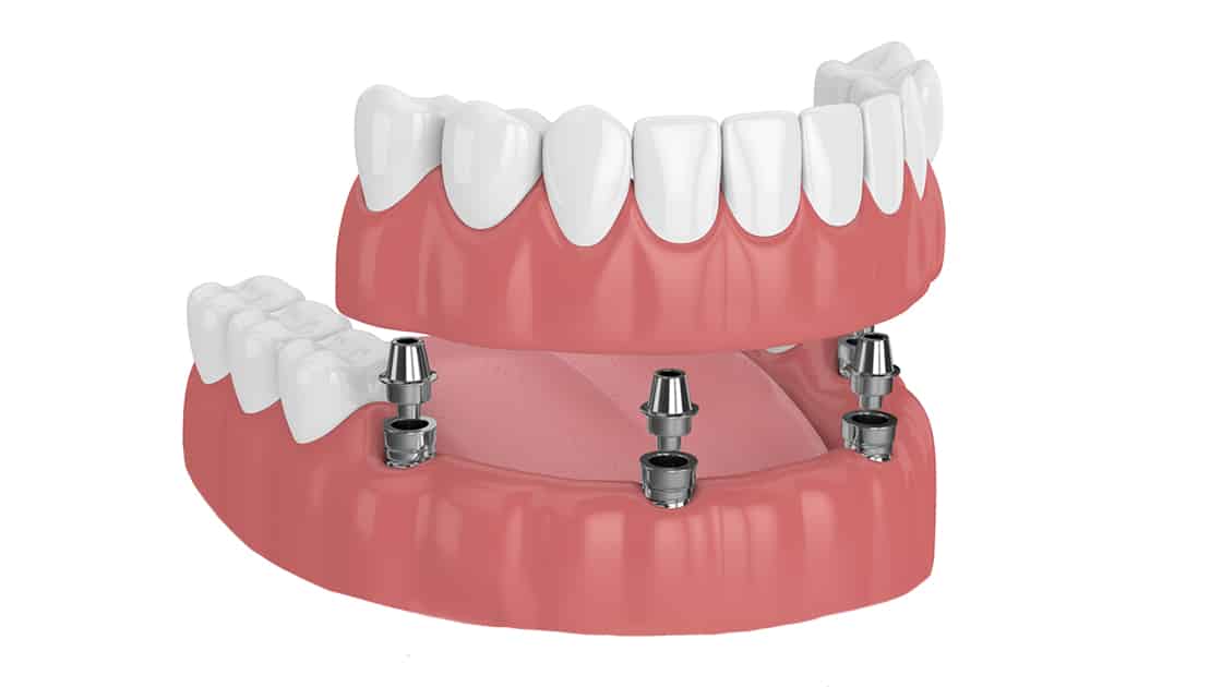 Partial Dentures Photo