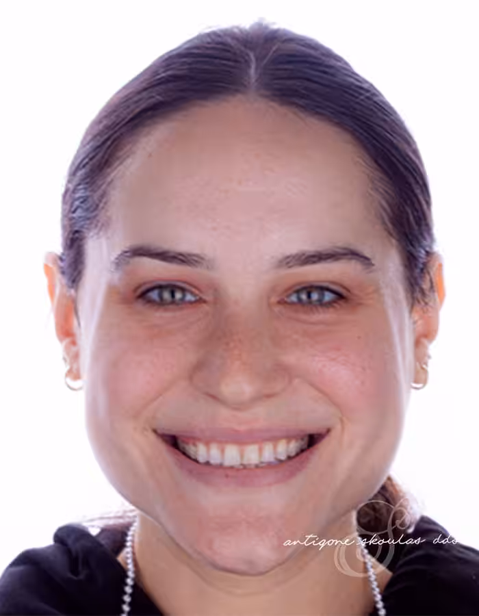 Porcelain Veneers Before Photo