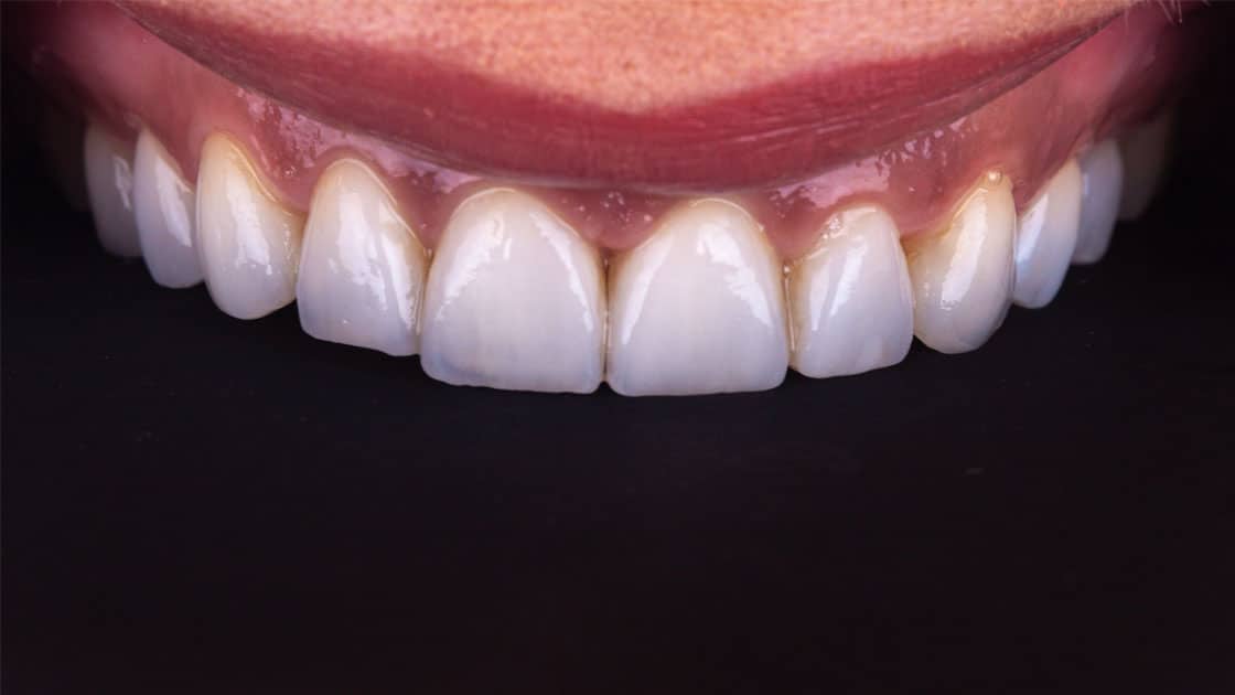 VENEERS AFTER TEETH