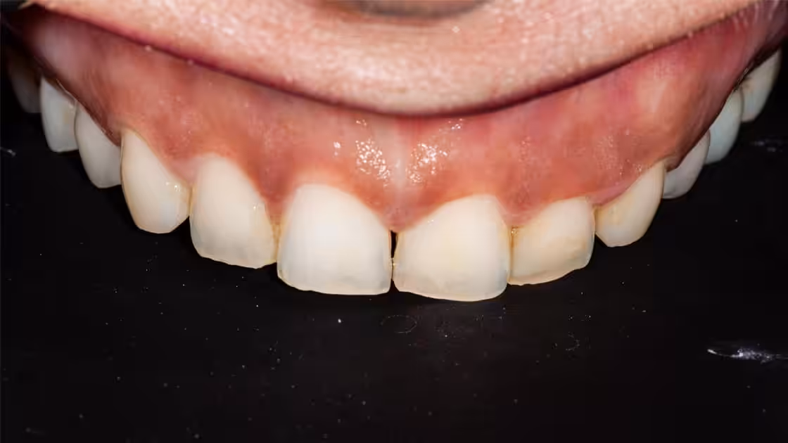 valery VENEERS BEFORE TEETH