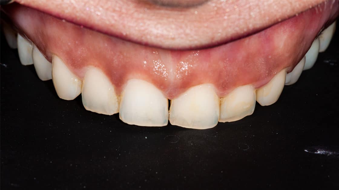 VENEERS BEFORE TEETH