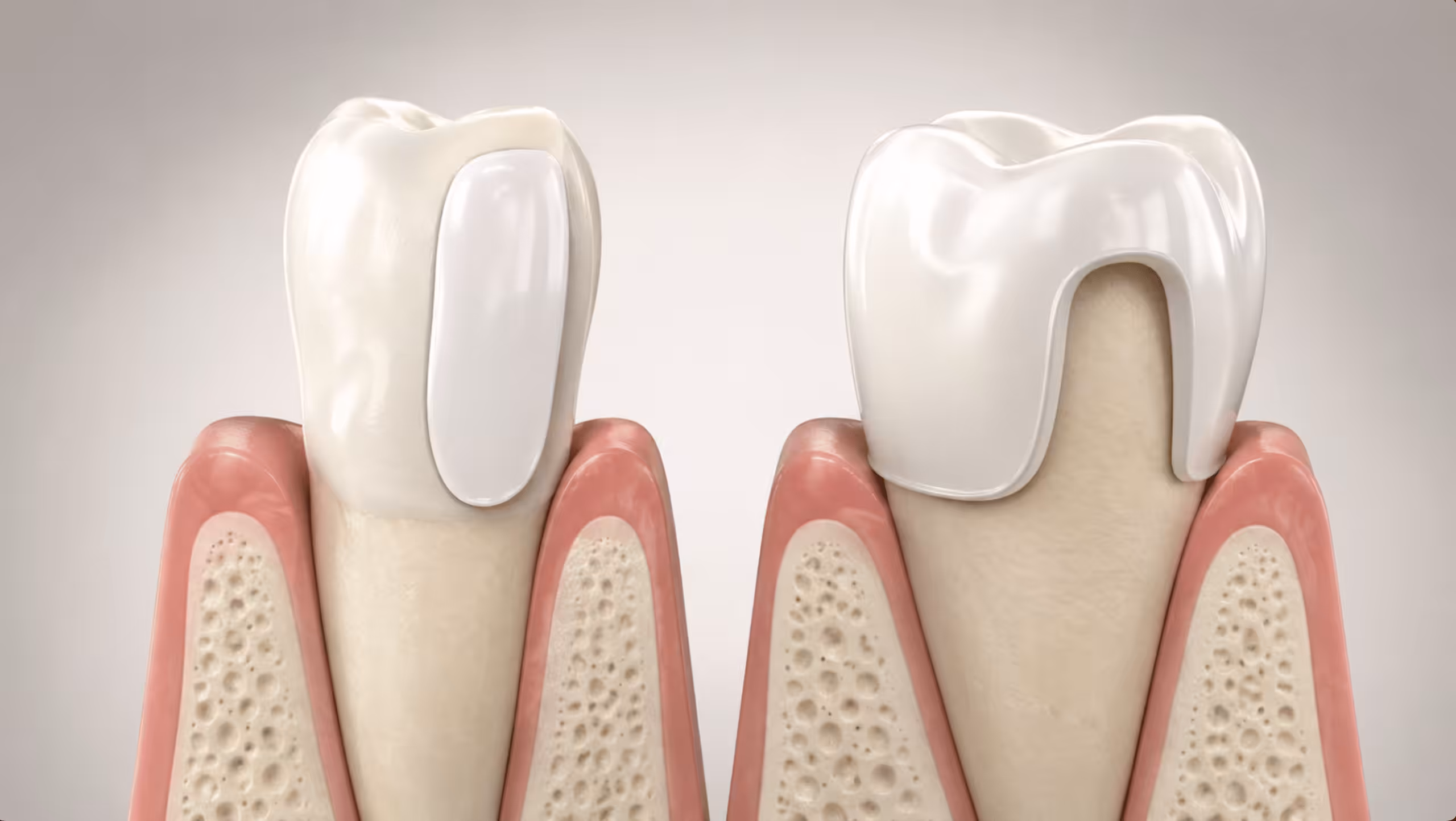 Illustration comparing a porcelain veneer and a dental crown on natural teeth