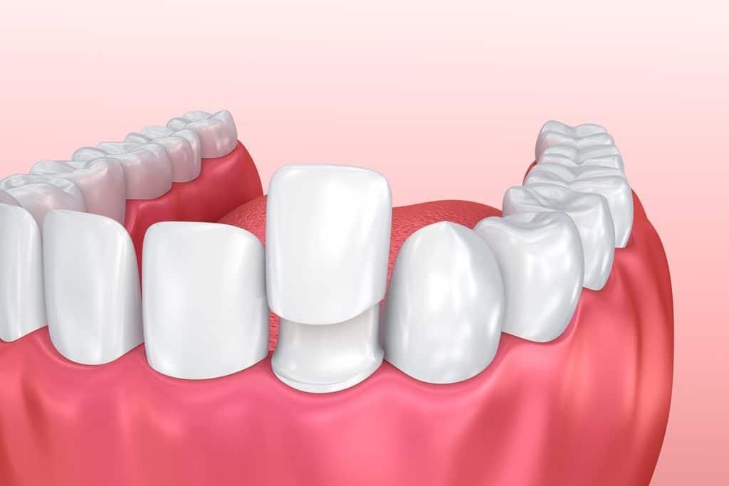 What is a Dental Veneer?