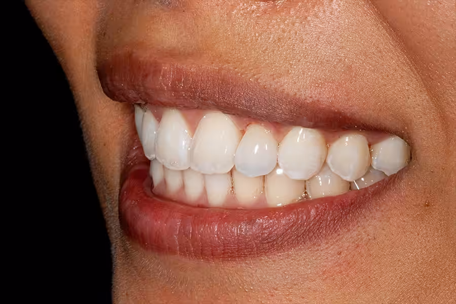 Whitening Photo